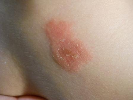 Червоні шершаві плями на тілі у дитини: що робити?