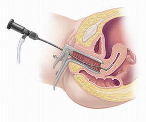 Що таке гістероскопія матки, як правильно підготуватися до операції