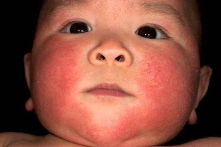 Себорейний дерматит у дітей