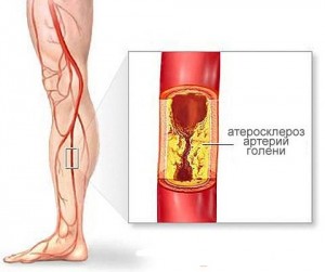 Атеросклероз судин нижніх кінцівок