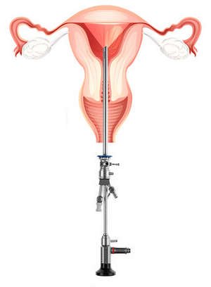 Що таке гістероскопія матки, як правильно підготуватися до операції