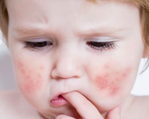 Харчова алергія у дітей