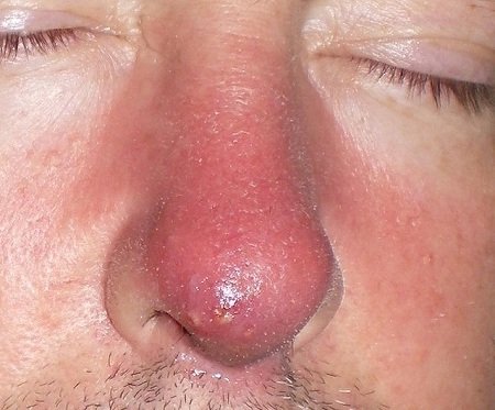 Як вилікувати фурункул на носі: народні і традиційні методи лікування