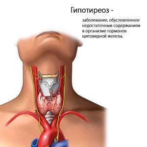Спосіб життя щитовидної залози при гіпотиреозі