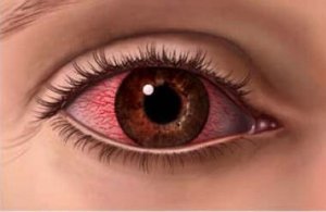 Червоні очі: симптоми і лікування кератиту!