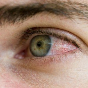 Як вибрати краплі для очей від втоми