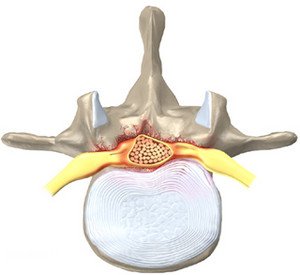 Що таке стеноз хребтового каналу, і як його лікувати?