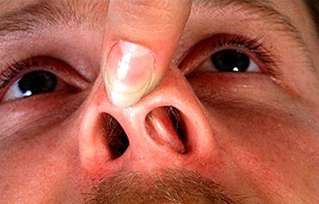 Основні симптоми та методи лікування викривлення носової перегородки