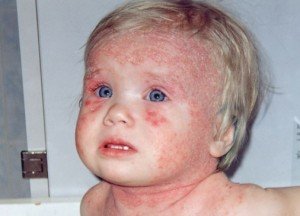 Алергічний дерматит у дорослих і дітей