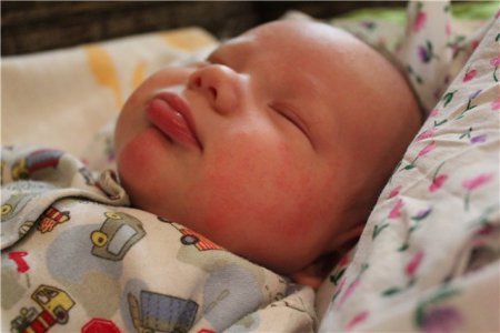 Алергія у новонароджених на обличчі