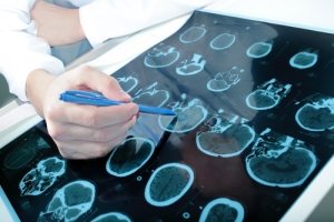 Перші симптоми і народне лікування менінгіоми головного мозку