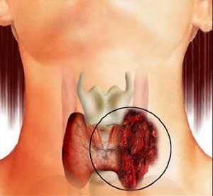 Спосіб життя щитовидної залози при гіпотиреозі