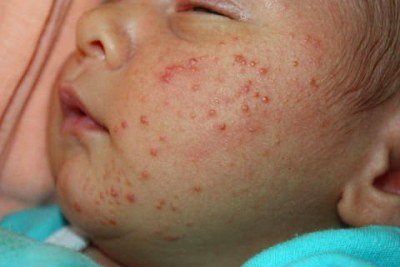 Алергія у новонароджених на обличчі