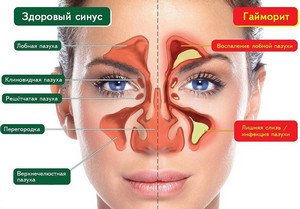 Як і чим вилікувати гайморит?