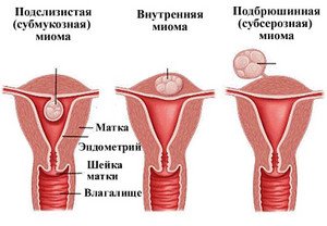 Міома матки – симптоми, наслідки та методи лікування захворювання