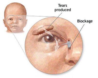 Зондування слізного каналу у новонароджених
