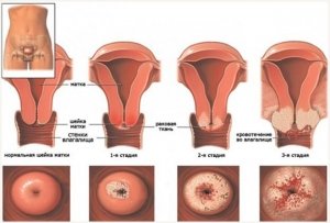 Опис і лікування лейкоплакії шийки матки