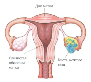 Кіста жовтого тіла яєчника