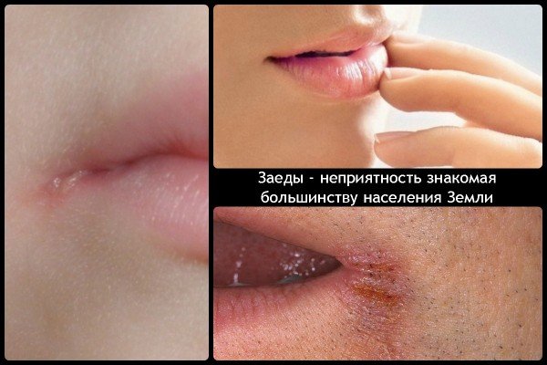 Заїди — причини, симптоми і народні методи лікування осіннього недуги