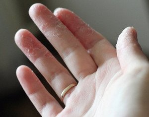Чому тріскається шкіра між пальців на руках?