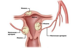 Міома матки – симптоми, наслідки та методи лікування захворювання