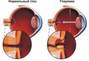 Глаукома: не пропустіть початок хвороби!
