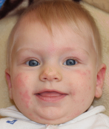 Алергія на еспумізан у новонароджених