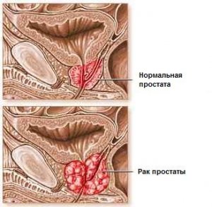 Хвороба без болю: рак передміхурової залози!