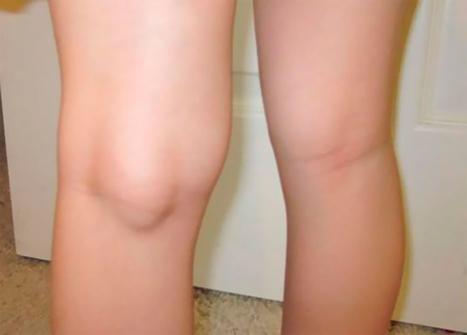 Кіста Беккера під коліном: причини, діагностика і як лікувати