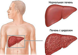 Гепатомегалія печінки, жировий гепатоз — причини, симптоми і лікування