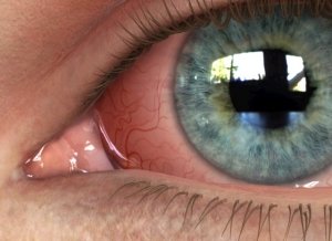 Народні поради та рекомендації, як швидко впоратися із запаленням очей