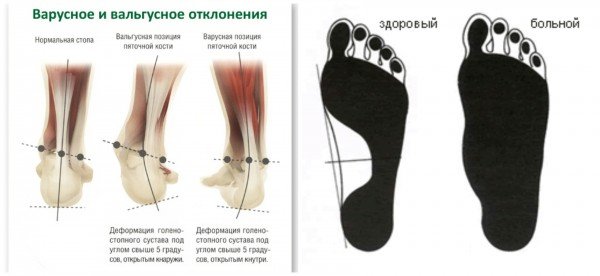 Лікування болів в ногах народними засобами