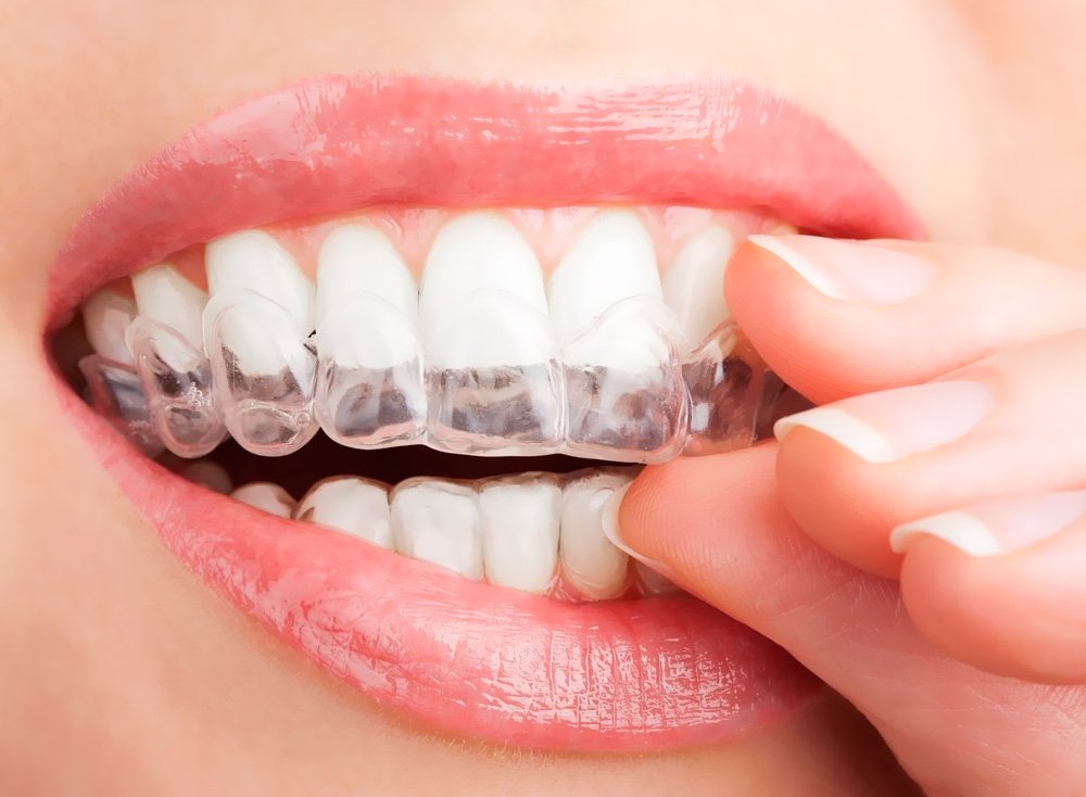 Як можна відбілити зуби, і всі способи безпечні?