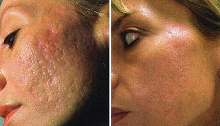 Вибираємо спосіб боротьби з рубцями на обличчі в залежності від виду пошкодження шкіри