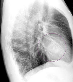 Навіщо потрібна рентгетограмма легенів, у чому її відмінність від флюорографії