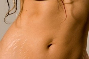 Розтяжки на тілі: як зробити шкіру красивою!