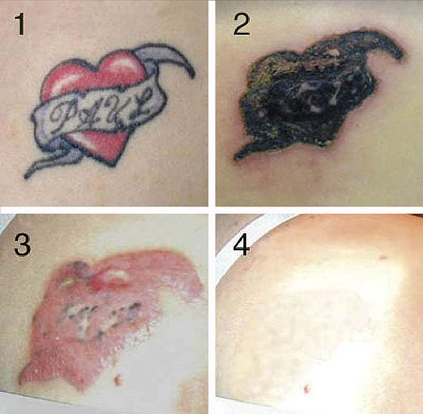 Як вивести татуювання лазером та іншими сучасними методиками