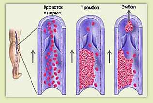 Профілактика тромбозу вен
