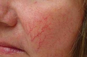 Купероз на обличчі — як лікувати захворювання?