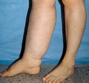 Лімфедема — лікування на ногах