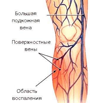 Тромбофлебіт поверхневих вен нижніх кінцівок