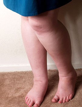 Як боротися з набряком ніг при вагітності