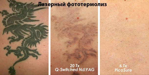 Як вивести татуювання лазером та іншими сучасними методиками