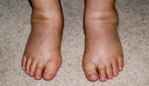 Як проходить лікування лімфедеми на ногах?
