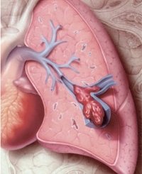Діагностика та лікування тромбоемболії легеневої артерії