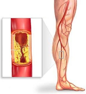 Симптоми і лікування атеросклерозу нижніх кінцівок
