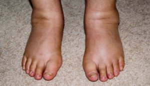 Лімфедема — лікування на ногах