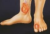 Лікування трофічних виразок на ногах