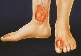 Ефективні методи лікування трофічних виразок на ногах