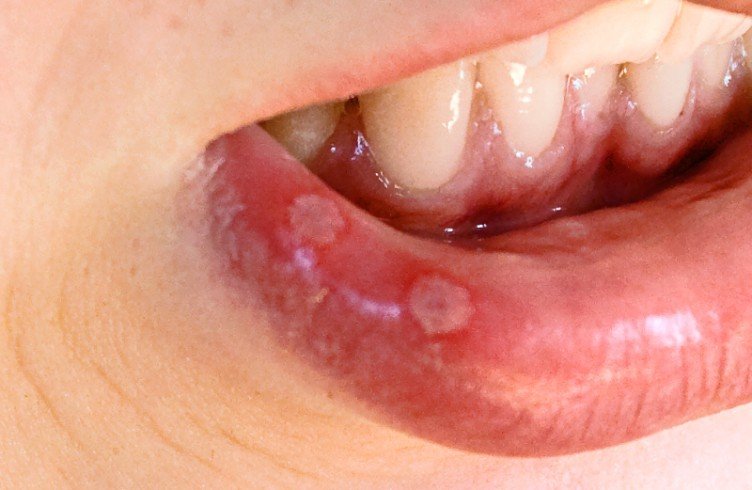Чому зявляється стоматит у роті у дорослих та лікування.
